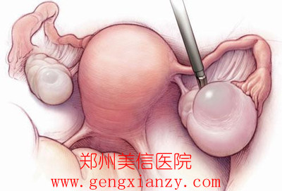 卵巢囊肿