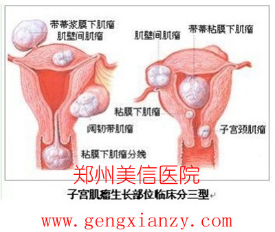 子宫肌瘤