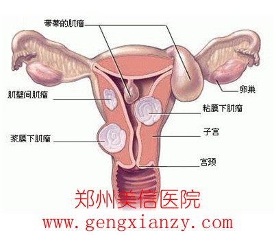 子宫肌瘤
