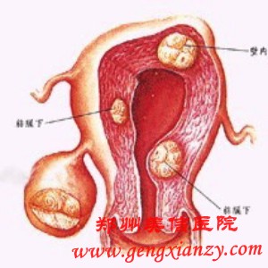 卵巢囊肿