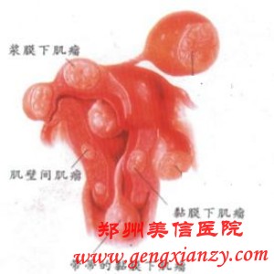 卵巢囊肿