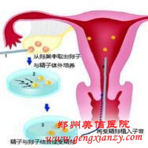 输卵管不通
