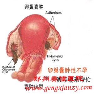 卵巢囊肿