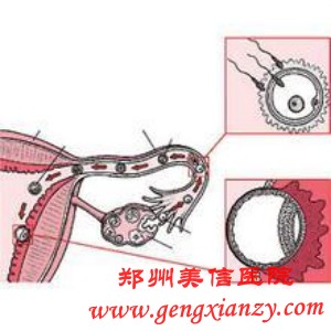 输卵管粘连