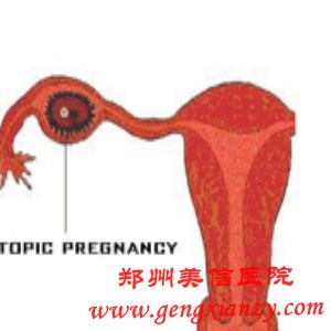 输卵管积水