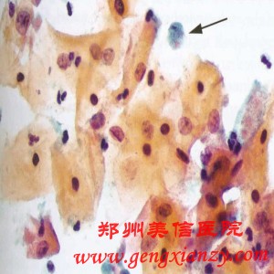 阴道炎