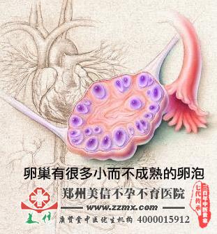 多囊卵巢