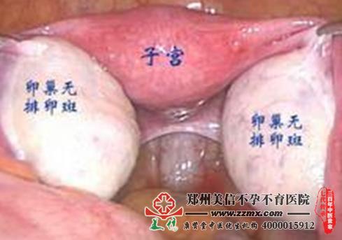 多囊卵巢