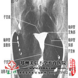 输卵管造影