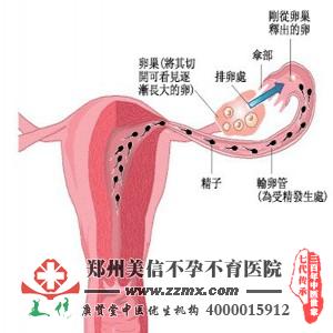 输卵管造影