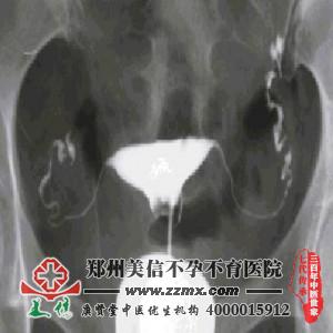 输卵管造影