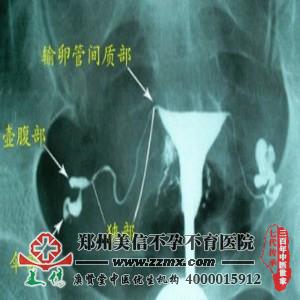 输卵管造影