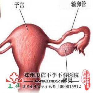 输卵管扭曲