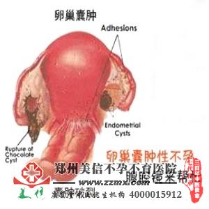 卵巢囊肿